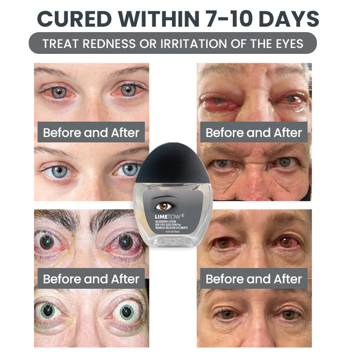 LIMETOW® Redness-Relief Eye Drops